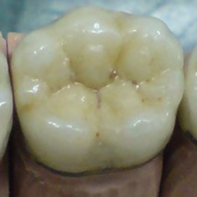 prótesis dentales a medida